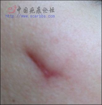 我脸上的疤痕怎么办啊，有人帮帮我吗？ 