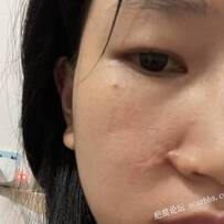 脸部凹陷疤痕，祛疤求助