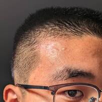 脸颊和额头的疤痕