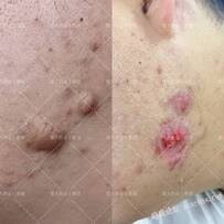 困扰了很多年的疤痕疙瘩