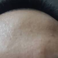 这种凹陷型的疤痕能不能去掉好烦啊