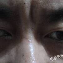 怎么治疗激光还是切除