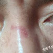凹陷疤痕激光后需要涂生长因子吗