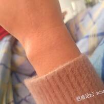 手上的疤还怎么去掉