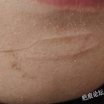 下頜處15年陳舊瘢痕