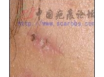 大家看看我切除后的疤痕呀！（有图）