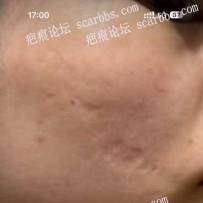 求问脸上深凹陷疤痕做激光有用吗？