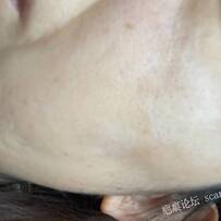 脸上十年的疤痕怎么治疗？