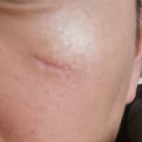 脸上意外划伤，伤口比较深