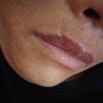 八大处哪个医生专业切缝唇疤痕？